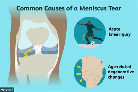 medial meniscus knee tear